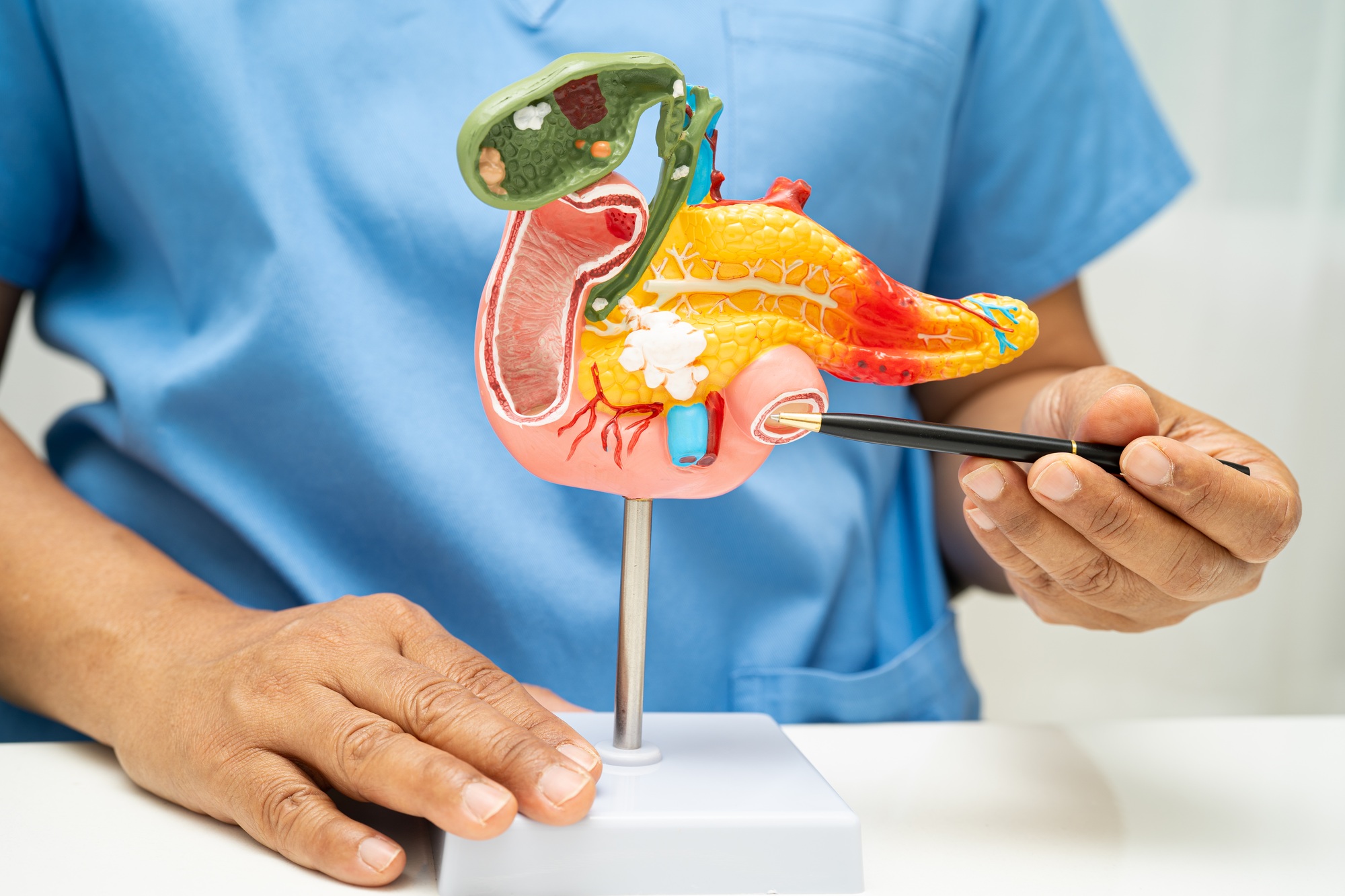Pancreatitis, pancreatic cancer, Asian doctor with pancreas, gallbladder